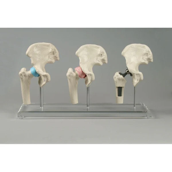 Hip Implant